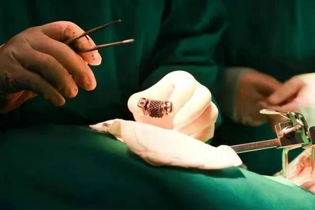 西安国际医学中心成功将3D打印可动人工颈椎-椎间盘复合体植入患者体内