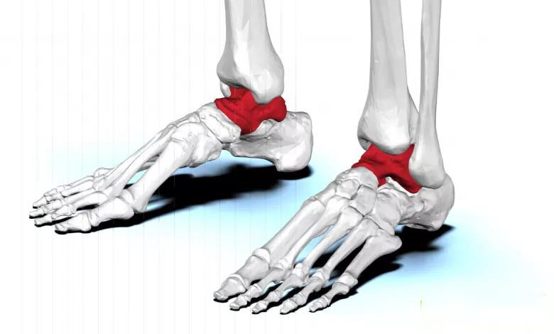 首个针对患者的3D打印距骨植入物获FDA批准